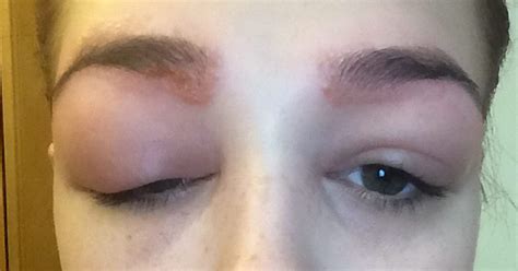 Eyes Dyed Shut Teenager Left Scarred After Disastrous Eyebrow Treatment