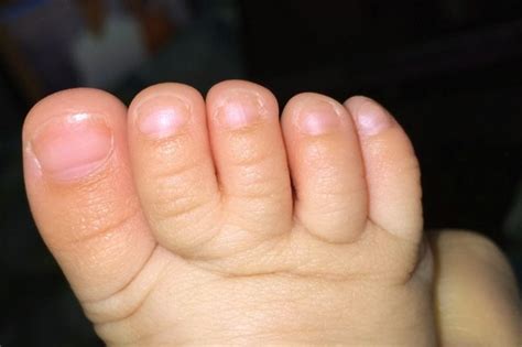 Webbed Toes Baby