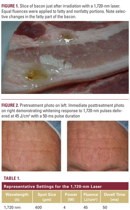 Treatment Of Sebaceous Hyperplasia With A Novel 1720 Nm Laser