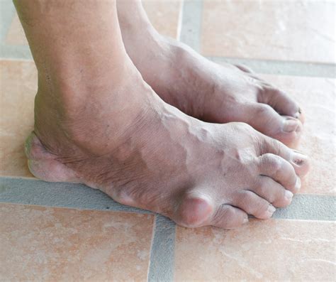 What Causes Gout In The Foot My Footdr