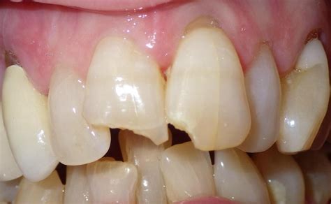 Dentist 02332 Chipped Teeth Repaired With Cosmetic Bonding