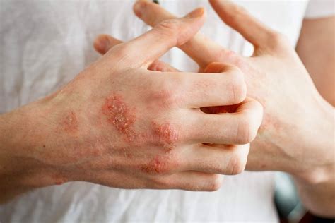 ¿eczema Atópico O Eczema De Contacto Por Laboratorio Géomer Ca Noticias