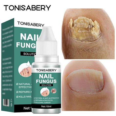 Antifungal Nail Treatment Foot Care Essence Nail Foot Toe Nail Fungus