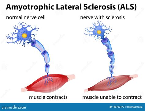 Amyotrophic Lateral Sclerosis Stock Photo 179281410