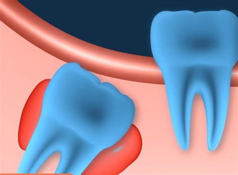 Full List Of 6 Dental Cyst Types What Is A Cyst On A Tooth How