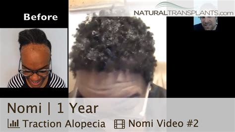 We did not find results for: Black Female Hair Transplant Before and After | "I love ...