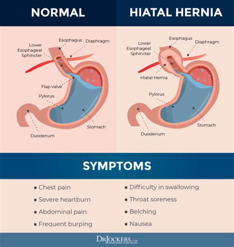 Hiatal Hernia Relief Hiatal Hernia Causes Symptoms Diagnosis And