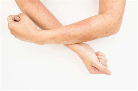 Understanding The 8 Different Types Of Dermatitis