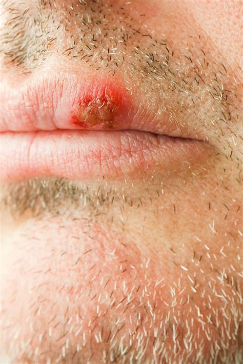 Blood Blister On Lip Treatment Causes And Remedies