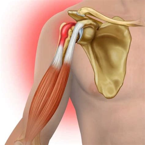 Arthroscopic Or Open Biceps Tenodesis Shoulder Surgeon South Windsor Enfield Glastonbury CT
