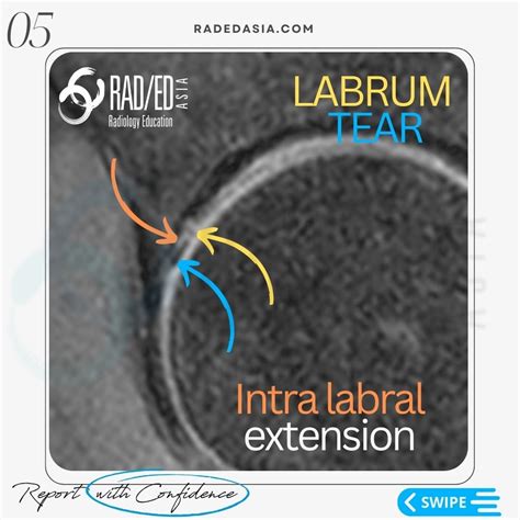 Hip Labrum Labral Tear Mri Radiology Radedasia