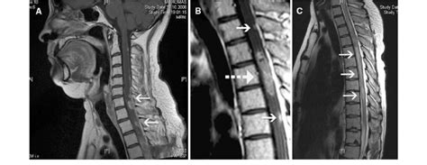 Contrast Enhanced T1 Weighted Mri Of The Spine Sagittal A Cervical