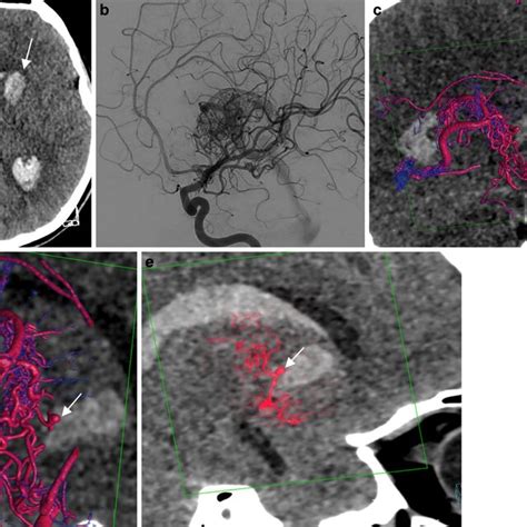 Ruptured Periventricular Arteriovenous Malformation Avm With An