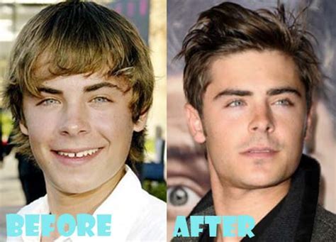Zac Efron Plastic Surgery Before And After Nose Job Lovely Surgery