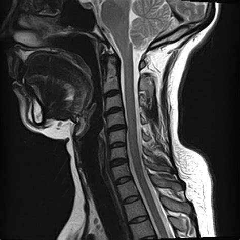 Cervical Spine Mri Neck