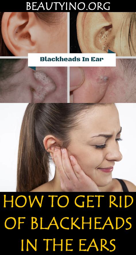 How To Get Rid Of Blackheads In My Ear Howtormeov