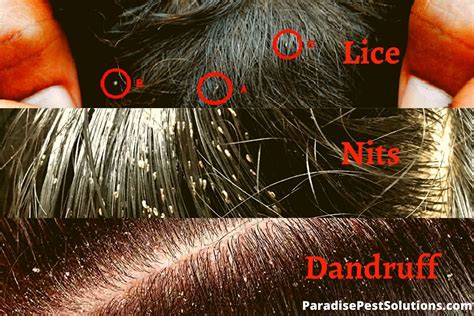 Lice Vs Dandruff How To Tell The Difference