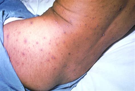 If you look at it from a different aspect, you will be able to see that there have been changes, but not visible. Varicella zoster virus - wikidoc