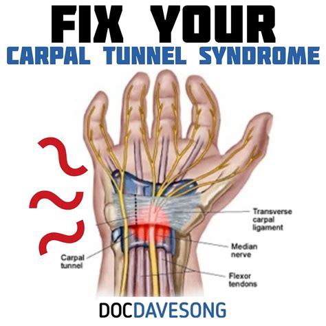 Dr David Song Dc On Instagram “🖐⚡ Rehab Your Carpal Tunnel Syndrome