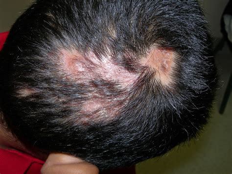 Ringworm And Folliculitis Best Hair Loss Products Reviews