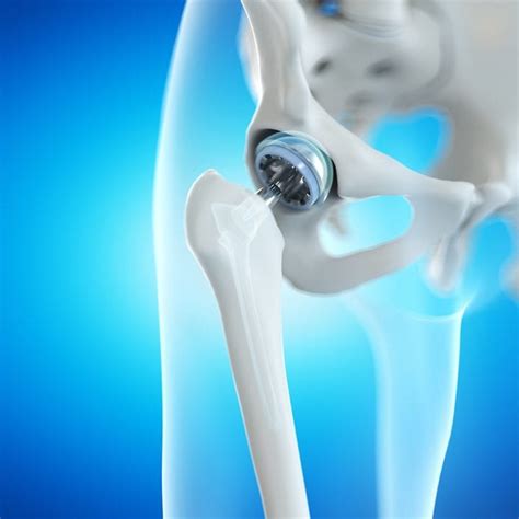 Anterior Hip Replacement Cedar Orthopaedic Surgery Specialty Clinic