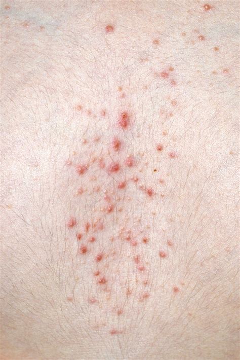 Crohns Disease Skin Rash Pictures Quotes Images