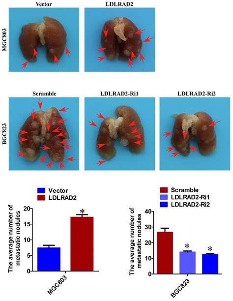 LDLRAD2 Overexpression Predicts Poor Prognosis And Promotes Metastasis