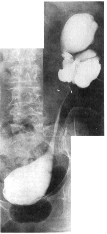 Postoperative Retrograde Pyelography After Combined Psoas Hitch And