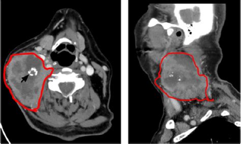 Aandb A Right Neck Mass At Level Iiaiii With A Cystic Component Red