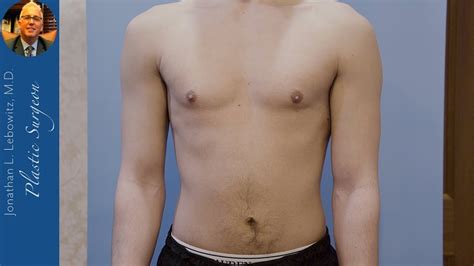 Gynecomastia Bothers You Get It Outgynecomastia Gland Surgery By Dr