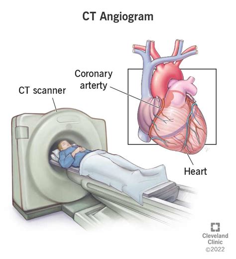 Ct Coronary Angiogram