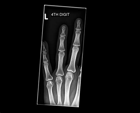 Orthodx Mallet Finger Clinical Advisor
