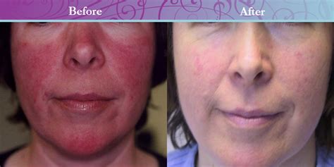 Before And After Vein Treatment On Face Your Magazine Lite