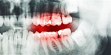 虫歯を放置するとどうなるの？ 虫歯を治療すべき絶対的な理由とは さいたま市南浦和の くろさき歯科