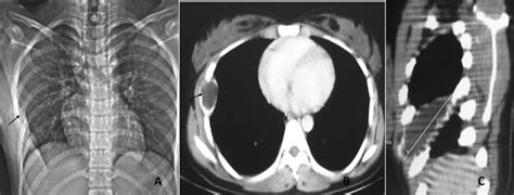 Simple Bone Cyst Of Rib The Annals Of Thoracic Surgery