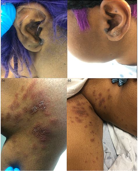 Cureus Atypical Subacute Cutaneous Lupus In A Patient On Apixaban