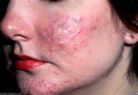 Acne Rosacea Symptoms Causes And Other Risk Factors