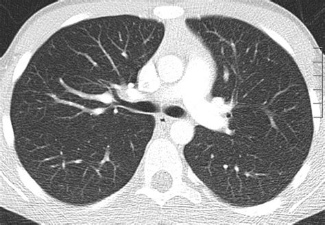 Ibalfourlynn Having A Ct Lung Scan Parent Information