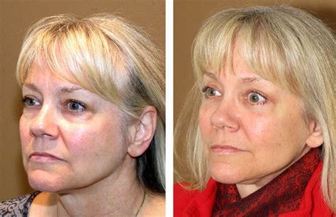 Are developing saggy jowls inevitable, and are you doomed to have the face of a bulldog the older you get? Raise And Tighten Sagging Hog Jowls Naturally With Facial ...