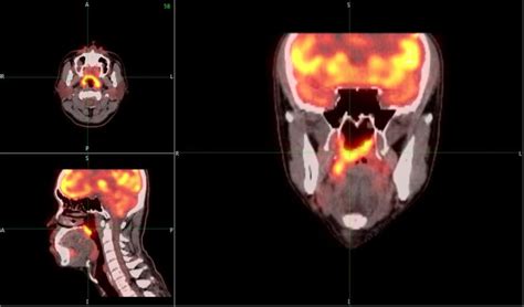 Kopf Hals Tumor Standardisierte Diagnostik Und Therapie Steigert