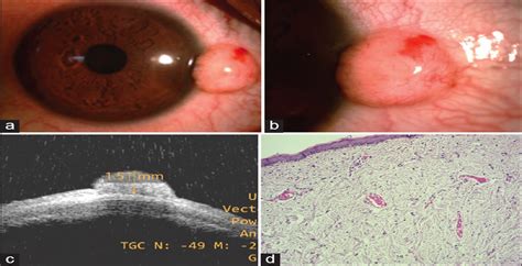 Conjunctival Stromal Tumor Oman Journal Of Ophthalmology