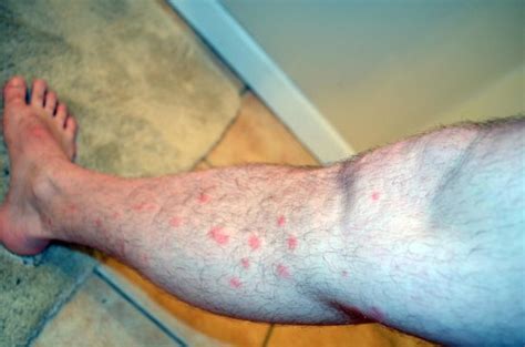 Bed Bug Bites On My Leg Picture Taken Evening The Same Day As Checkout