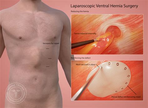 Incisional Hernia Recovery Time
