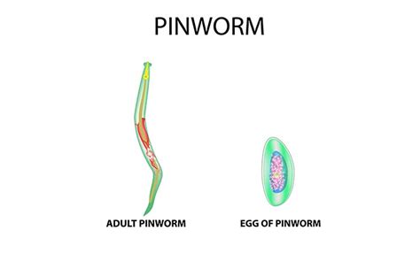 How To Get Rid Of Pinworms Causes 17 Home Remedies Prevention