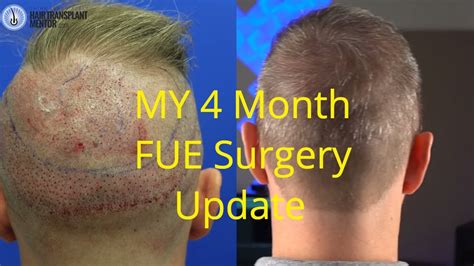 My FUE Hair Transplant Before And After 4 Months YouTube