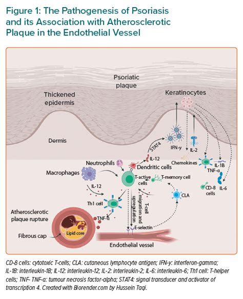 The Pathogenesis Of Psoriasis And Its Association With Atherosclerotic