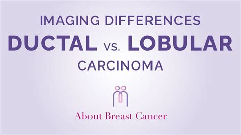 Imaging Differences Between Ductal And Lobular Carcinoma Youtube