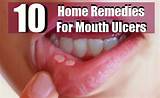 Mouth Infection Home Remedies