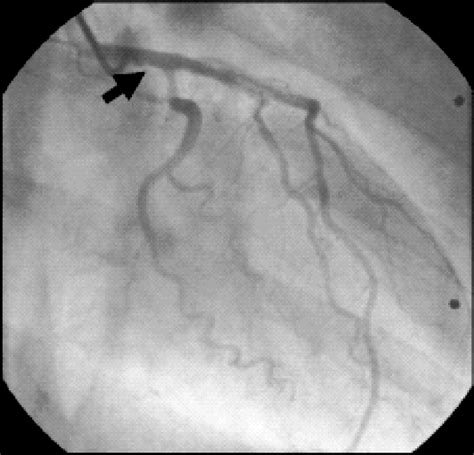 Spontaneous Coronary Artery Dissection Involving The Left Main Stem