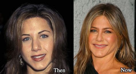 Jennifer Aniston Botox And Facial Fillers Latest Plastic Surgery